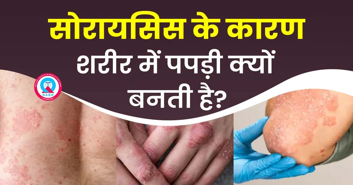 सोरायसिस-के-कारण-शरीर-में-पपड़ी-क्यों-बनती-है